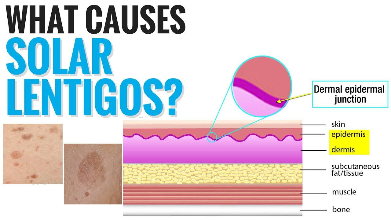 孚立美“氟轻松氢醌维A酸乳膏”能用于老年斑治疗吗？