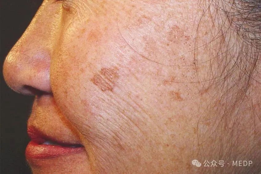 老年斑、晒斑、日光性雀斑是一回事吗？